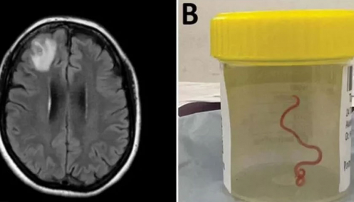 প্রথমবারের মতো মানব মস্তিষ্কে পাওয়া গেল জীবন্ত কৃমি