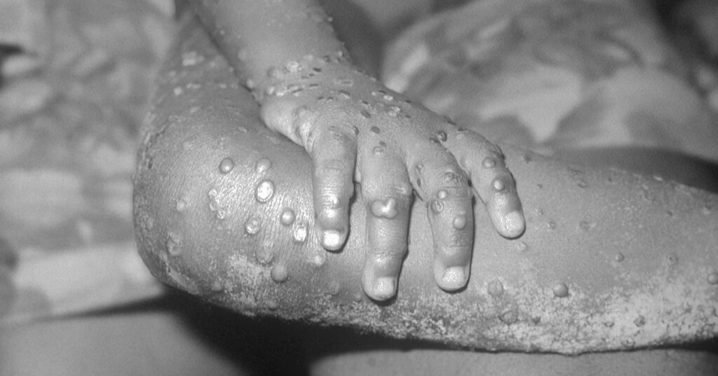 Mpox: Common signs and symptoms