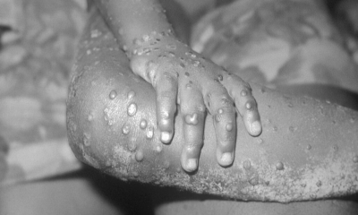 Mpox: Common signs and symptoms