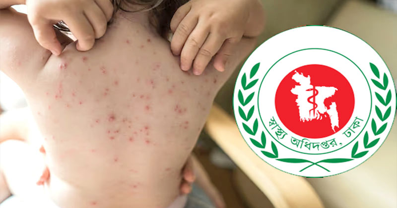 7 more children die with measles, symptoms, symptoms