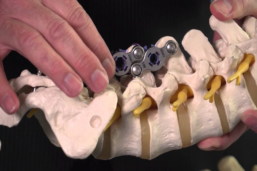 Paralysed spineless man walks with implant